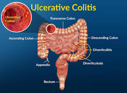 ulcerative colitis causes symptoms