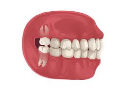 What is the recovery time for wisdom tooth removal? Wisdom Teeth Removal Cost Pain And Recovery Authority Dental