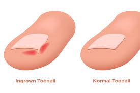 ingrown toenail prime imate care