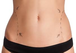 can you get liposuction on your belly