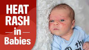 heat rash in infants reasons signs