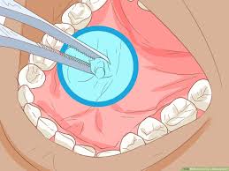 3 simple ways to unclog a salivary duct