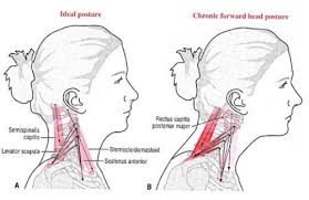 Shoulder causes of neck pain shoulder pain you experience may actually be referred from your neck to other areas, based on what's going on in your body systems. Text Neck Physiopedia