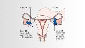 Ovarian cancer develops very rapidly even in the early stages, and advanced stage can occur in just one year. Ovarian Cancer Pictures Symptoms And Diagnosis