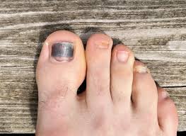 black toenail causes treatment and