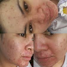 Sebenarnya kulit kita menjadi kering kerana suhu yang tinggi. Pengalaman Ngeri Selepas Guna Produk Ta Skincare Lekat Lekit Story