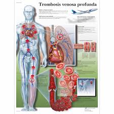 Esta página encontraras algo más de información ya que se habla poco o nada de esto ,compartir. Trombosis Venosa Profunda 1001867 Vr3368l Cardiovascular System 3b Scientific