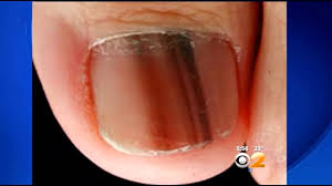 doctor if you notice black on your nail