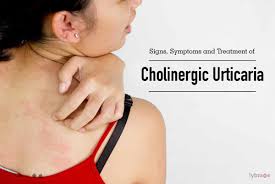 treatment of cholinergic urticaria
