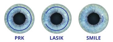 laser vision correction wv eye