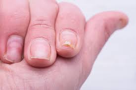 psoriatic nail dystrophy ociated