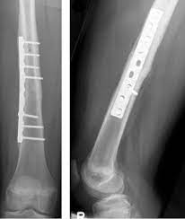 fem shaft fractures trauma