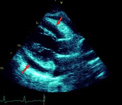 Full recovery is most likely with rest and ongoing care, which can help reduce your risk of getting it again. Cureus A Conundrum Of Diagnostic Analogy Between Constrictive Pericarditis And Pericardial Tamponade