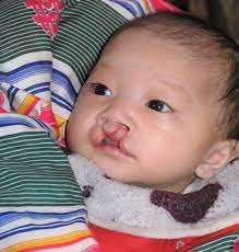 why cleft lip and palate need to be