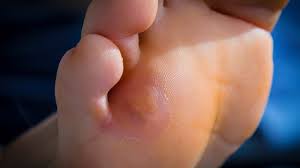 how to get rid of calluses naturally