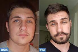 8 minoxidil beard before and afters. Beardless Men Are Rubbing Hair Loss Drug On Their Face For Fuller Fuzz But Experts Warn It Could Fall Out