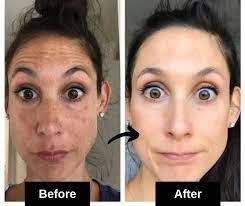 natural remes for dark spots on face