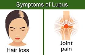 diffe types of lupus lupus911