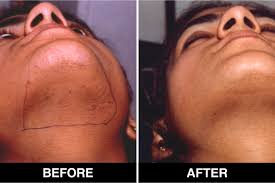 laser hair removal treatment in delhi