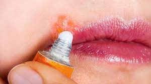 cold sores causes and prevention