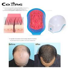 We can safely use these lights to promote hair restoration for patients with androgenic alopecia (female pattern hair loss), traction alopecia, and telogen effluvium. Hair Steamer Thermo Cap 678nm Laser Therapy Hair Growth Helmet Regrowth Device Hair Loss Treatment With 80 Led Beads Buy At The Price Of 337 41 In Aliexpress Com Imall Com
