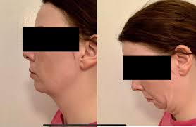 Maybe you would like to learn more about one of these? Had Disappointing Chin Lipo Results Now Looking To Augment With An Implant Or Genio What Procedures Will Help Define My Jaw Line And Create An Angle Between My Chin And Neck I