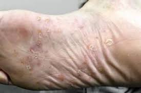 Read how diet impacts psoriasis, whether it's contagious, and the outlook for cure. Psoriasis Skin Disorders Merck Manuals Consumer Version