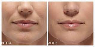 botox for lip lines or wrinkles care