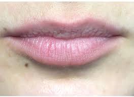 thin lips lip filler treatment dr yusra