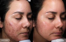 the best laser treatment for acne