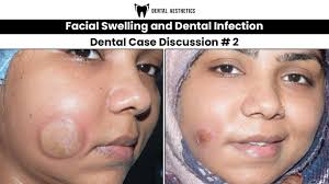 face swelling tooth infection can