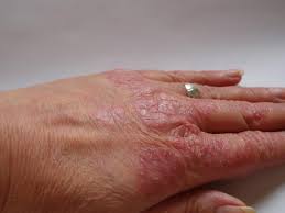 Image result for PSORIASIS