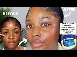 how vaseline helped clear my acne and