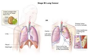 Non Small Cell Lung Cancer Program In Cleveland Oh