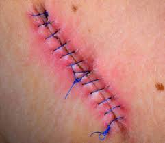 skin cancer mohs surgery scars hy
