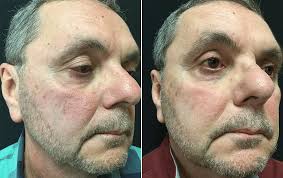 rosacea redness treatment with laser