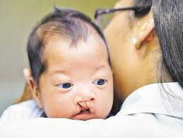 2 000 free cleft lip operations in 7
