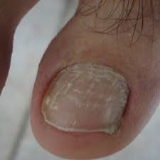 white superficial onychomycosis and