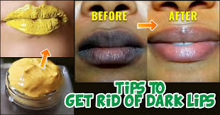 10 home remes to lighten dark lips