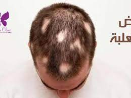 alopecia areata the most important 5
