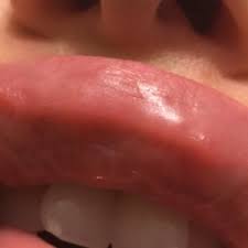 hard lumps in lip two weeks after