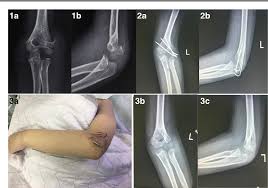 Repetitive overuse of the tendons can cause. Figure 2 From Comparative Study Of Lateral Condyle Fracture With Or Without Posteromedial Elbow Dislocation In Children Semantic Scholar