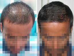 acell hair loss therapy in dubai