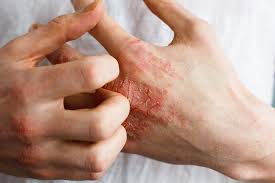 a brief introduction to eczema types