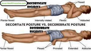decorticate posture vs decerebrate