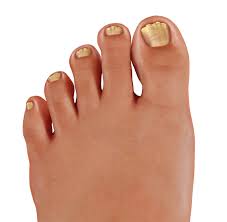 laser therapy for nail fungus is it