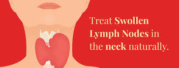 treat swollen lymph nodes in neck naturally