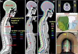 supine craniospinal irradiation using a