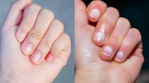 4 possible causes of nail issues