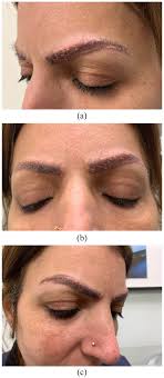 cutaneous sarcoidosis in eyebrows